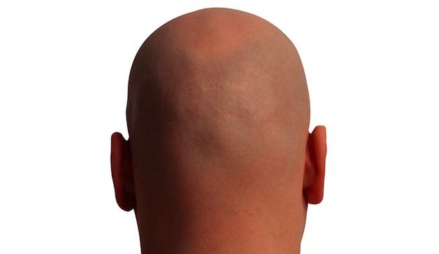 Dayı kelse kellik riski daha fazla