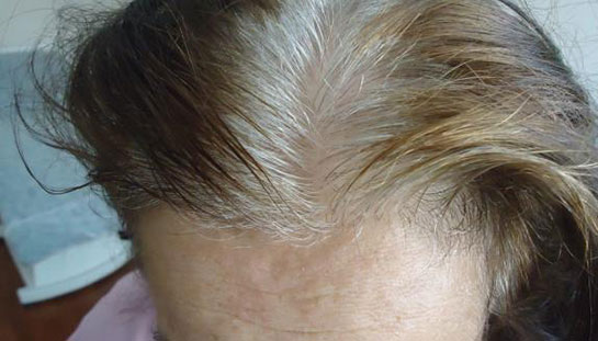 Kadınlarda saç dökülmesi