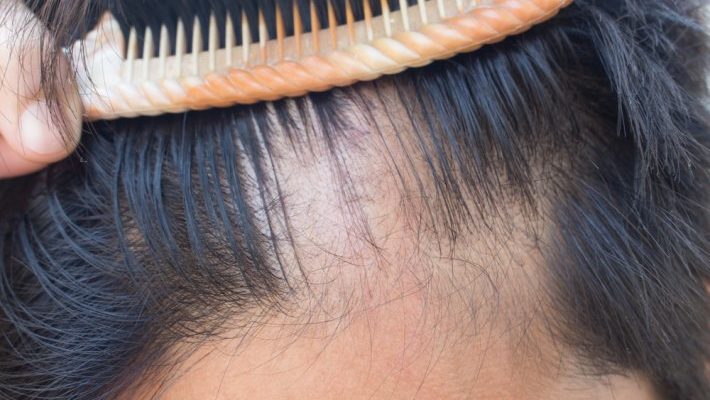 Saç hastalıklarına dikkat !