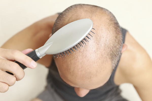 Benim de saçım dökülecek mi ?